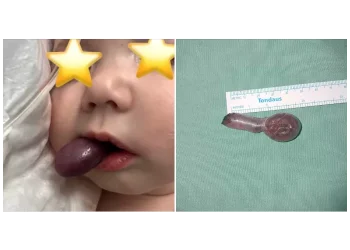 ΠΑΓΝΗ: Επιτυχής αντιμετώπιση σπάνιου περιστατικού σε βρέφος