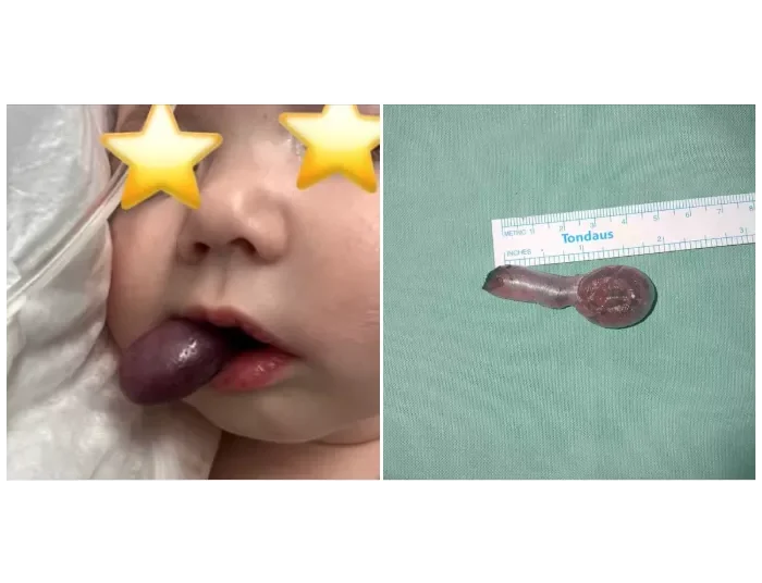 ΠΑΓΝΗ: Επιτυχής αντιμετώπιση σπάνιου περιστατικού σε βρέφος